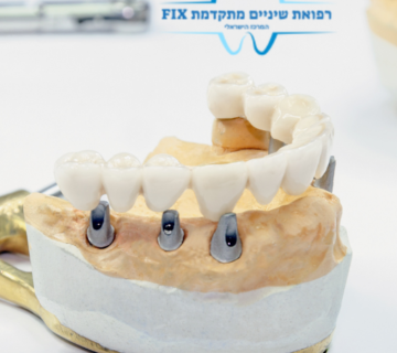 השתלות שיניים 360x320