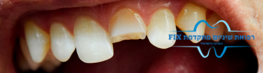 עלות תיקון שן שבורה כמה עולה לתקן